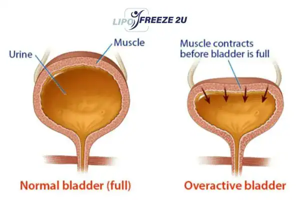diagram of overactive bladder treatment Surrey