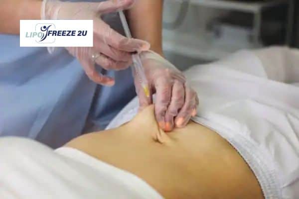 How Does Aqualyx Fat Dissolving Injection Work to Break Down Fat Surrey?