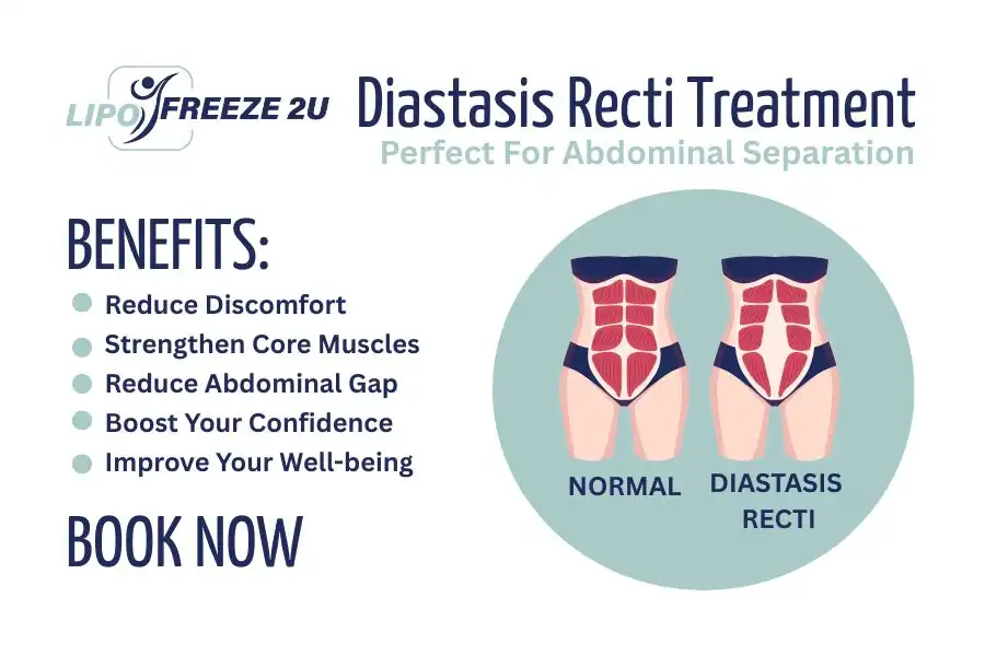 How Long Will It Take to See Improvements in Diastasis Recti Surrey