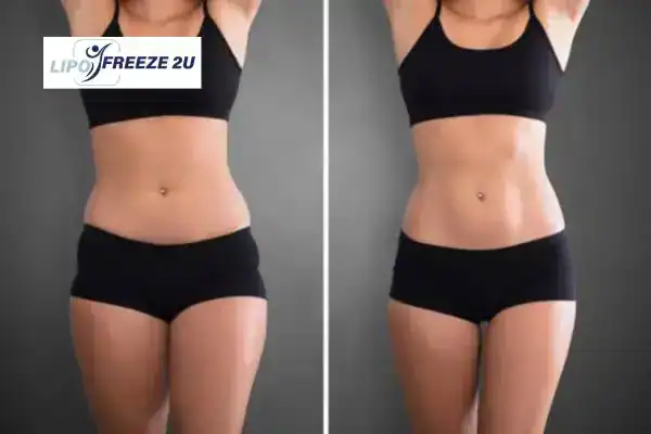 How Can LIPO FREEZE 2U Support Your Post-Pregnancy Body Recovery Surrey?