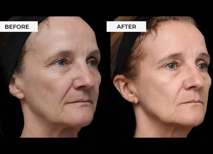 How Many RF Microneedling Sessions Will You Need to See a Difference Surrey?