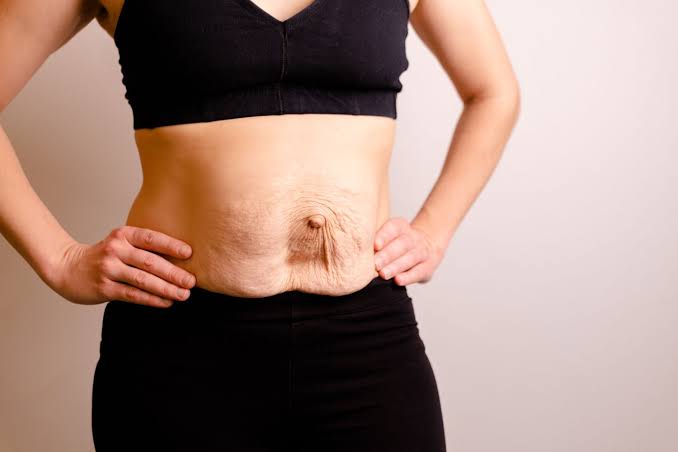 Is Surgery Really the Only Way to Repair Diastasis Recti Surrey?
