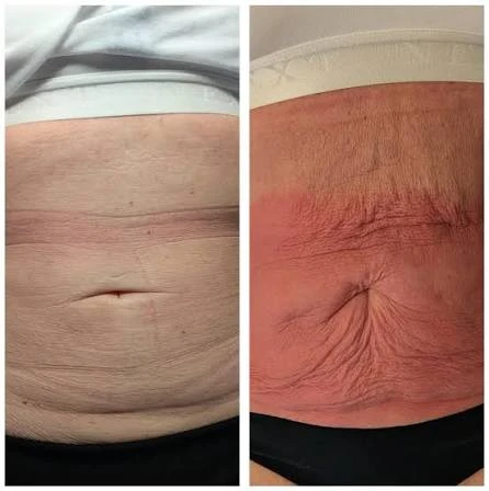 How Does RF Microneedling Improve Crepey, Thin and Uneven Skin Texture Surrey?