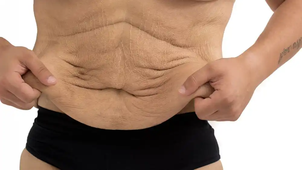 Why Does Weight Loss Medication Leave Some People With Loose or Sagging Skin Surrey?